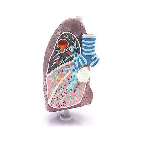 Diseased Lung Medical Model Pulmonary Anatomy Respiratory System for Patient Education