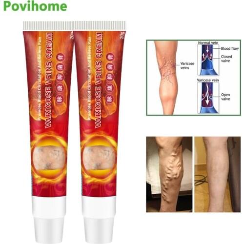 2pcs Sumifun Varicose Veins Cream 100% Original Vasculitis Phlebitis Spider Medical Plaster Pain Relief Patch Ointment Skin Care