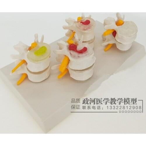 Lumbar Pathology model Lumbar disc disease model Intervertebral disc pathology demonstration model