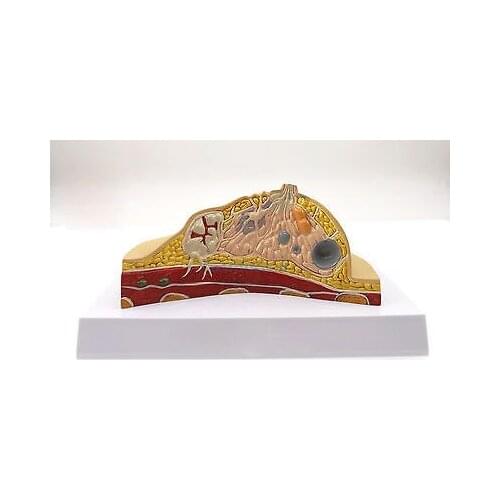 Anatomical Human Pathological Breast Model Medical Disease & Cancer Anatomy for Patient Education