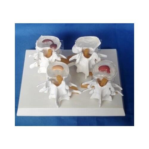 Medical human Lumbar disc hernia Demo Model spine model free shipping