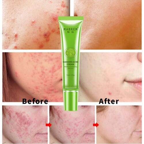 MABREM Acne Treatment Skin Care Remove Acne Oil Control Oil Shrink Pores Whitening and Moisturizing Scar Removal Facial cream