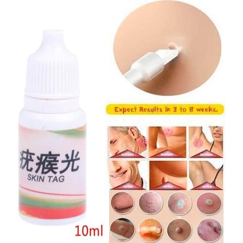 Really Work Body Warts Corn Mole Genital Wart Treatment Cream Skin Tag Remover Foot Corn Removal Plantar Genital Warts Ointment