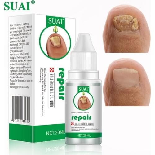 SUAI 20ML Nail Fungal Treatment Feet Care Essence Nail Foot Toe Nail Fungus Removal Gel Anti Infection Paronychia Onychomycosis