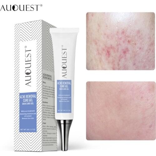 Effective Acne Removal Cream Acne Treatment Gel Fade Acne Spots Shrink Pores Oil Control Whitening Moisturizer Smooth Skin Care