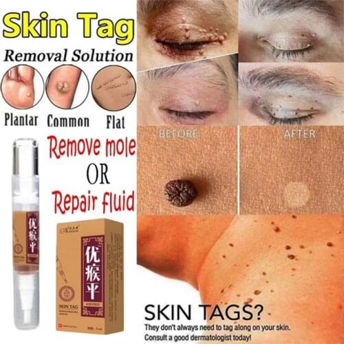 Skin Tag Remover 12 hours Medical fast Removal Mole & Genital Wart Foot Corn Treatment Kit skin Care Anti Wart Bacteriostatic