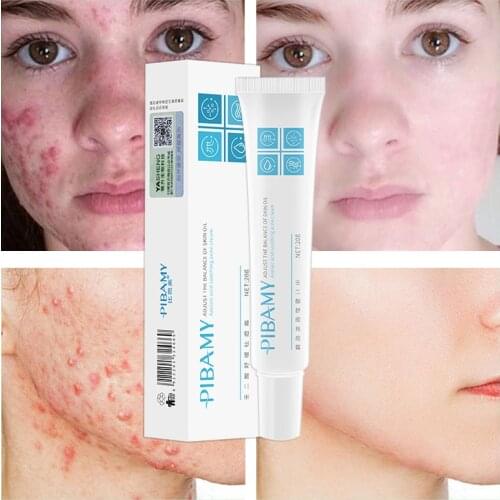 Effective Acne Remover Cream Herbal Acne Treatment Desalination Imprint Acne Scar Removal Cream Whitening Face Gel Skin Care 30g