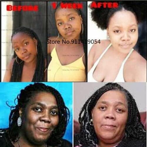 Super Bleaching Serum Alpha Arbutin Skin Care Permanent Whitening Serums Dark Lightening Cream Kojic Acid Brightening