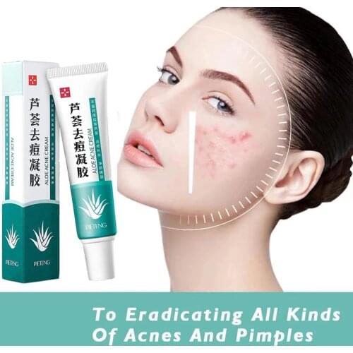 Effective Acne Removal Cream Acne Treatment Fading Acne Spots Oil Control Shrink Pores Moisturizing Acne Cream Skin Care