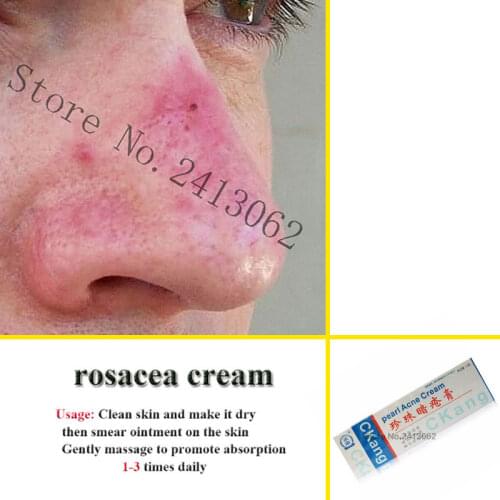 Rosacea cream Red nose ointment remove blackhead acne cream Skin care herbal anti acne and mite acne rosacea treat Shrink Pores