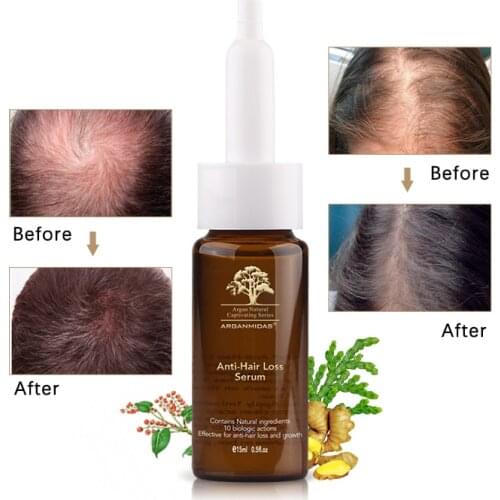 ARGANMIDAS Hair Loss Remedies