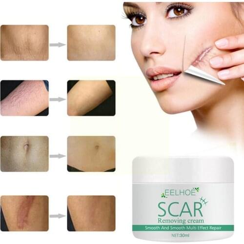 30ml Removal Cream Repair Acne Spots Acne Treatment Skin Pores Care Marks Blackhead Stretch Shrink Whitening E4E0