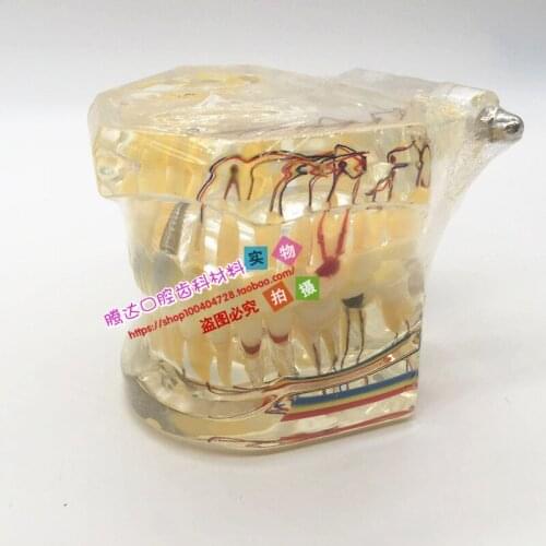 Human model Dental pathology model Doctor-patient communication demonstration Planting nerve repair free shipping