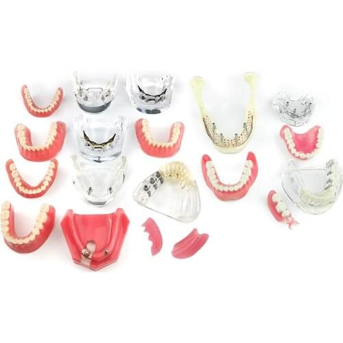 Dental Overdenture Teeth Model Removable Interior Mandibular Lower Teeth Model Mandibular with Implant for Tooth Teaching Study