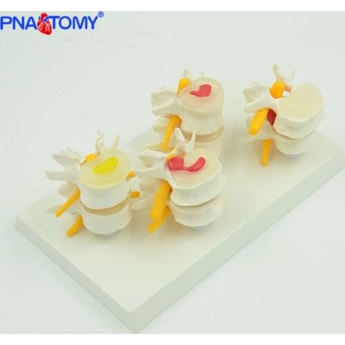 Medical props model human lumbar lesion spine structure display model 1 set medical teaching learning tool life size PNATOMY