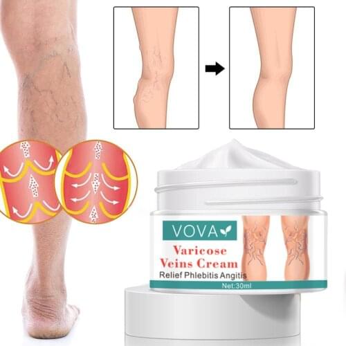 30ml Original Varicose Veins Cream Treat Vasculitis Phlebitis Remove Spider Swelling Pain Relief Ointment Medical Plaster
