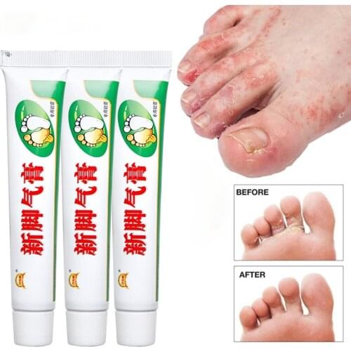 3Pcs Foot Cream Foot Corn Removal Athletes Erosive Beriberi Anti Itching Sweat Odor Feet Psoriasis Antibacterial Ointment