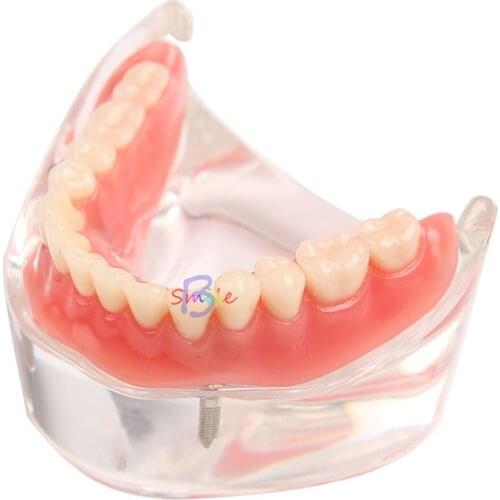 1pcs Dental Over denture Inferior Teeth Model With 2 Implant Demo Teeth Study Model