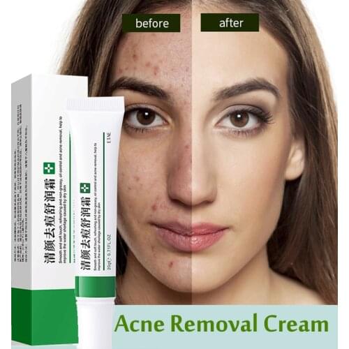 Effective Acne Removal Cream Acne Repair Treatment Fade Acne Spots Oil Control Shrink Pores Whitening Moisturizing Acne Cream
