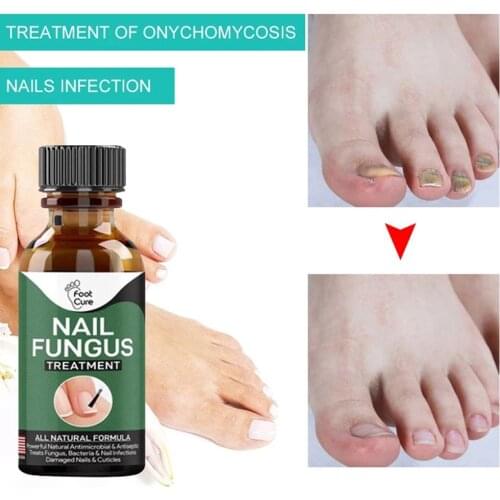 Nail Repair Liquid Nail Fungus Removal Anti Onychomycosis Feet Care Nourishing Brighten Nail Toe Care Treatments Nail Tools