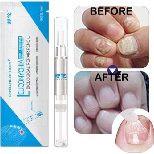 1pc Fungal Nail Treatment Pen Effective Onychomycosis Paronychia Fungal Infection Repair Solution Fingernail Toenail Foot Care