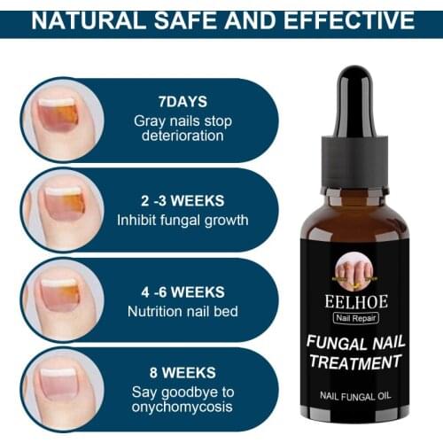 10/20/30/50ml Nails Repair Liquid Nail Care Fungal Nail Antifungal Nail Repair Liquid Nail Care Tool Fungus Toe Nail Care TSLM2