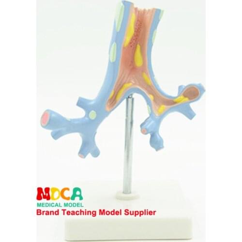 Demonstration of Bronchial Pathological Model Respiratory Pathological Bronchitis Model Medical Teaching MHXXT002