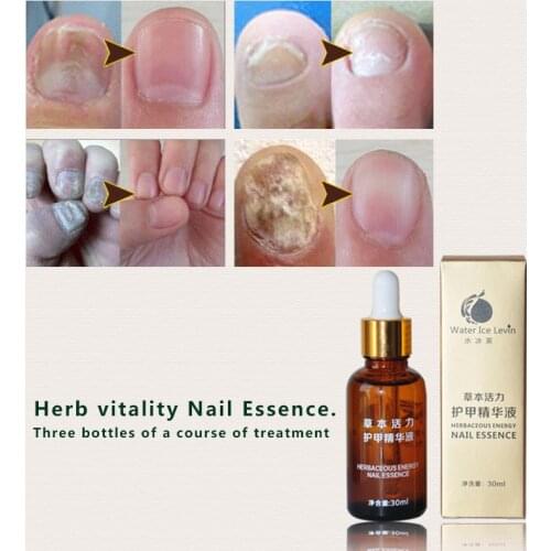 Chinese Medicine Fungal Nail Treatment Essence Nail and Foot Whitening Toe Nail Fungus Removal Feet Care Nail Gel 30ml