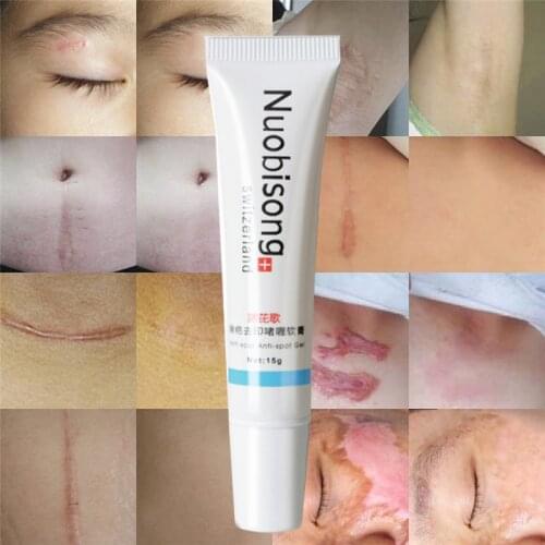 Nuobisong Remove Scar Cream Remove Acne Spots Remove Striae Gravidarum Pigmentation Corrector Anti-Aging Moisturizing 15ml