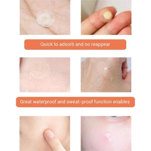 LANBENA Waterproof Day Use Acne Sticker Pimple Remover Patch Skin Care Treatment