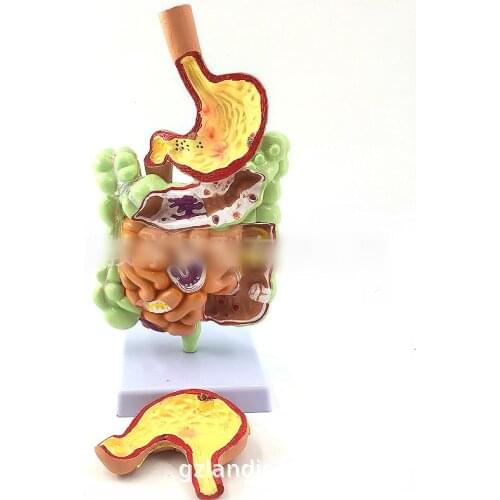 Pathological model of large intestine stomach model of large intestine disease model of human colon disease