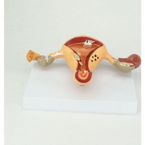 Pathological Uterus and Ovary Anatomical Model Human Female Medical Anatomy Learning Kit
