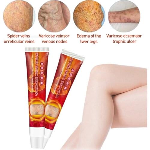 20g Vasculitis Phlebitis Spider Herbal Cream Varicose Veins Ointment Varicosity Angiitis Removal Herbal Medical Plaster