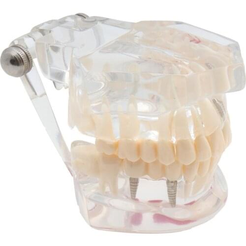 Teeth Model Implant Restoration Dental Model Transparent Study Analysis Demonstration Bridge