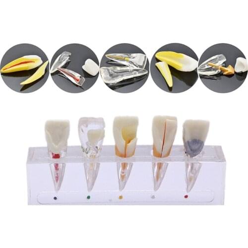 1Set Endodontic pathological model pathology Patient communication model Endodontic Teeth Dental Pulp Restoration