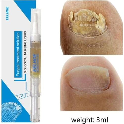 3ml Fungal Nail Treatment Pen Onychomycosis Paronychia Anti Fungal Nail Infection Chinese Medicinal Liquid Healthy Nail Care