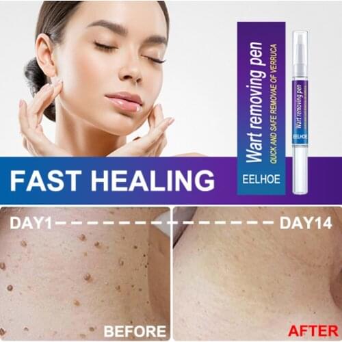 Skin Tag Remover Against Mole & Genital Wart Genital Wart Treatment Anti Foot Corn Removal Warts Moles Removing