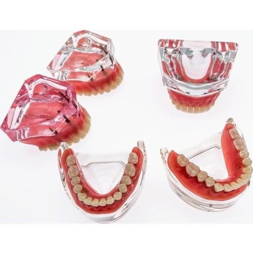 Dental Overdenture Superior upper/Lower jaw for Teaching Study 4 Implants/2 Implants Teeth Model