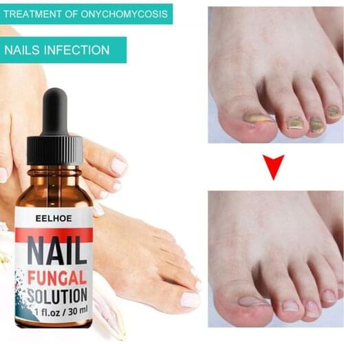 10/20/30ml Foot Anti-fungal To Remove Onychomycosis Repair Treatment Liquid Healthy Nail Care Repair Liquid