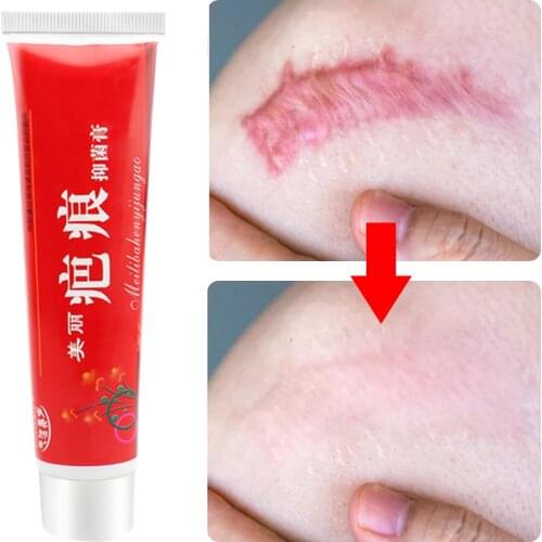 Scar Removal Cream Acne Scars Gel Stretch Marks Surgical Scar Burn Acne Marks Repair and Moisturize Skin Repair Cream 60g