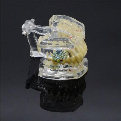 Dental Implant Disease Tooth Pathological EXTRUSION MISSING TEETH MODEL 4001