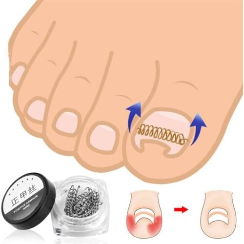12pcs/box Nail Art Ingrown Toenails Correction Wire Fixer Recover Care Paronychia File Patch Corrector Foot Pedicure Tools