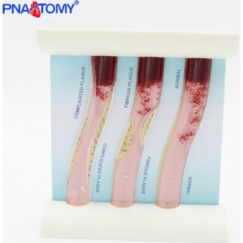 Blood vessel model human arteries hyperlipidemia Medical Teaching Tool Anatomy Educational Equipment Anatomical Blood Cell