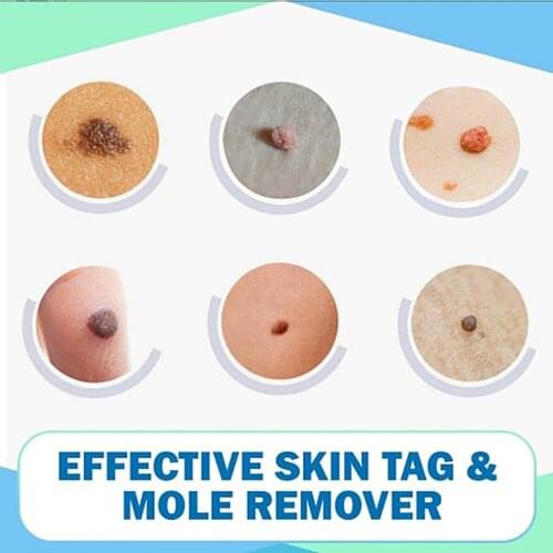 Tags&Moles Remover Pen Wart Remover Device Natural for Face WipeOff Tags