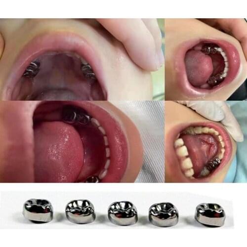 5pcs/Box Dental Kids Primary Molar Crowns Stainless Steel Pediatric Anteriors Posterior Crown Lower Left/Right