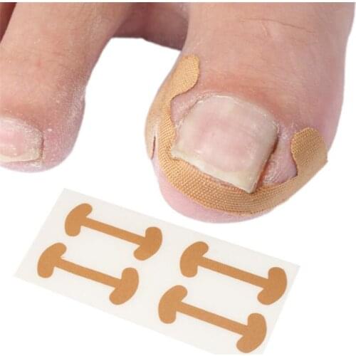 20pcs Professional Embedded Toe Nail Corrector Sticker Toenail Care Pedicure Thumb Curl Correction Sticker Foot Straightening
