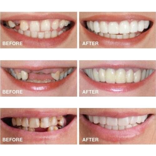 Updated Snap-On Tooth Veneers Fake False Teeth Denture Bright White Shade Fake Teeth Instant Smile Teeth Cosmetic