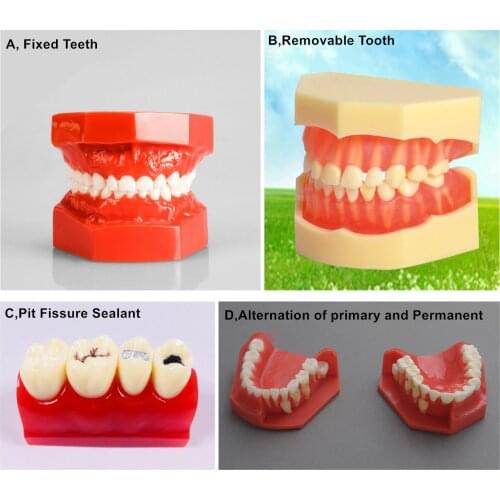 4Kinds Dental Pediatric Children Teeth Model Kids Demonstration Alternation Primary Permanent Pit Fissure Caries Sealant