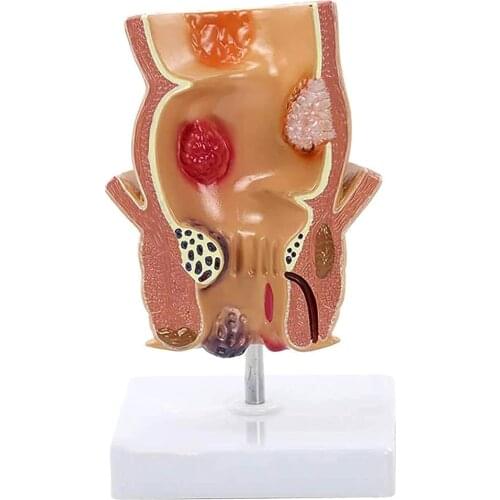 Rectal Pathological Model Hemorrhoid Model Hemorrhoids Rectal Pathological Model Medical Teaching Demonstration
