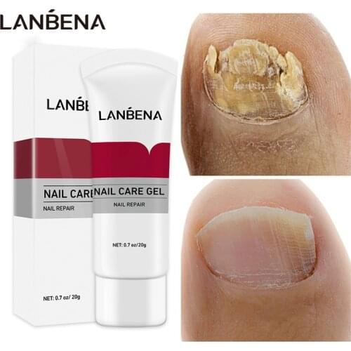 Nail Fungal Treatment Feet Care Essence Nail Foot Whitening Toe Nail Fungus Removal Gel Anti Infection Paronychia Onychomycosis